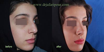 جراحی زیبایی بینی,جراحی بینی,جراحی پلاستیک بینی