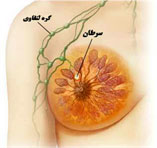 سرطان سینه, بیماری زنان, درمان سرطان سینه