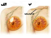 سرطان سینه, بیماری زنان, درمان سرطان سینه