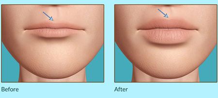 جراح پلاستیک صورت, حجم دادن به لب, برجسته سازی لب