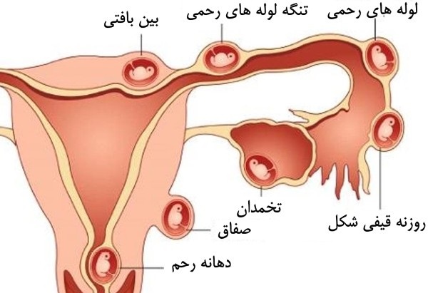 علل و علائم و روش های پیشگیری و درمان بارداری خارج از رحم