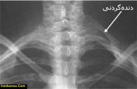 عمل جراحی دنده گردنی