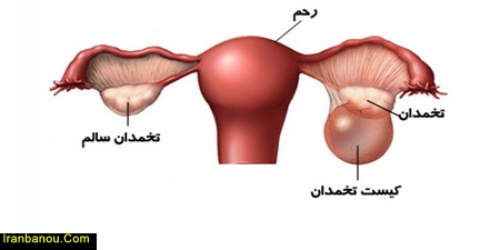 درمان کیست تخمدان با سیاه دانه ، انواع کیست تخمدان درمان کیست تخمدان با رازیانه