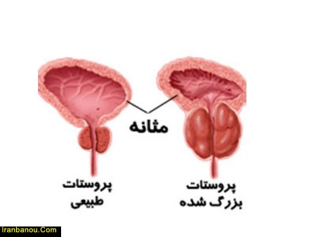 درمان قطعی پروستات با طب سنتی