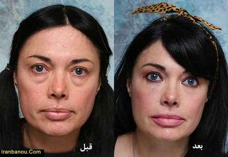 عوارض عمل افتادگی پلک جای بخیه عمل پلک
