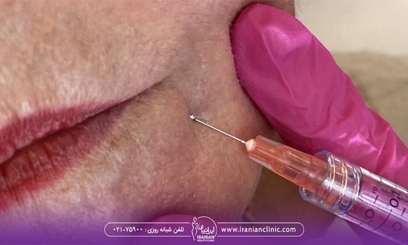 پزشکی که زیر لب زن پروفایلو تزریق می کند