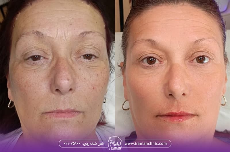 عکس قبل و بعد تزریق پروفایلو به صورت زن